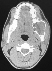 220px-CT Scan of ameloblastoma.jpg