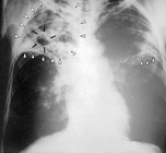 200px-Tuberculosis-x-ray-1.jpg