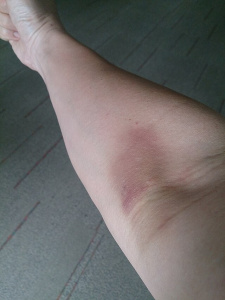 Bruise 2.jpg